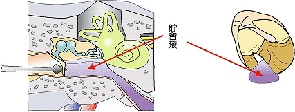 鼓膜切開